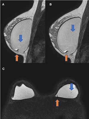 Case Report: Evidence of Migratory Silicone Particles Arising From Cohesive Silicone Breast Implants
